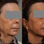 Laser Lift Precision Tx Before and After Photos in Newburgh, NY, Patient 13229