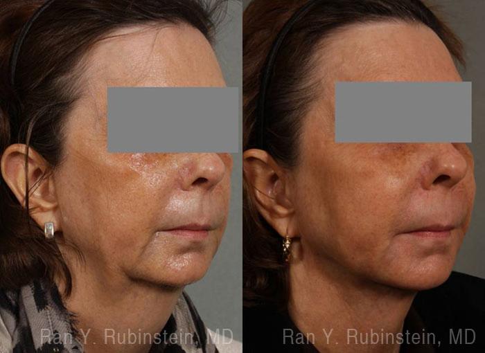 Laser Lift Precision Tx Before and After Photos in Newburgh, NY, Patient 13229