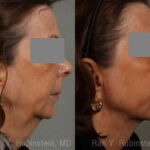 Laser Lift Precision Tx Before and After Photos in Newburgh, NY, Patient 13229