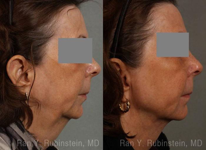 Laser Lift Precision Tx Before and After Photos in Newburgh, NY, Patient 13229