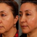 Laser Lift Precision Tx Before and After Photos in Newburgh, NY, Patient 13234