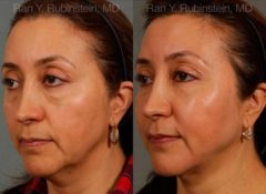 Laser Lift Precision Tx Before and After Photos in Newburgh, NY, Patient 13234