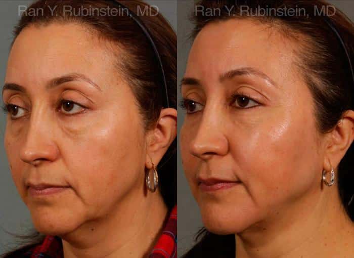 Laser Lift Precision Tx Before and After Photos in Newburgh, NY, Patient 13234