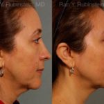 Laser Lift Precision Tx Before and After Photos in Newburgh, NY, Patient 13234