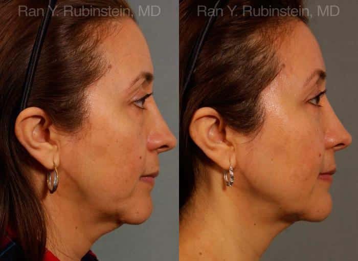 Laser Lift Precision Tx Before and After Photos in Newburgh, NY, Patient 13234