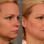 Laser Lift Precision Tx Before and After Photos in Newburgh, NY, Patient 13239