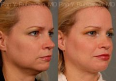 Laser Lift Precision Tx Before and After Photos in Newburgh, NY, Patient 13239