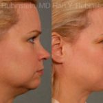 Laser Lift Precision Tx Before and After Photos in Newburgh, NY, Patient 13239