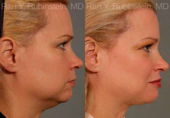 Laser Lift Precision Tx Before and After Photos in Newburgh, NY, Patient 13239