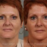 Laser Lift Precision Tx Before and After Photos in Newburgh, NY, Patient 13253