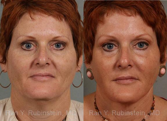 Laser Lift Precision Tx Before and After Photos in Newburgh, NY, Patient 13253