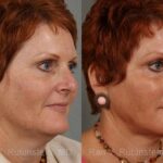 Laser Lift Precision Tx Before and After Photos in Newburgh, NY, Patient 13253