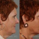 Laser Lift Precision Tx Before and After Photos in Newburgh, NY, Patient 13253