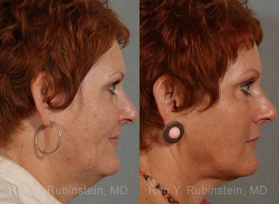 Laser Lift Precision Tx Before and After Photos in Newburgh, NY, Patient 13253