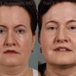 Laser Lift Precision Tx Before and After Photos in Newburgh, NY, Patient 13260