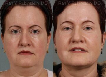 Laser Lift Precision Tx Before and After Photos in Montvale, NJ, Patient 13260