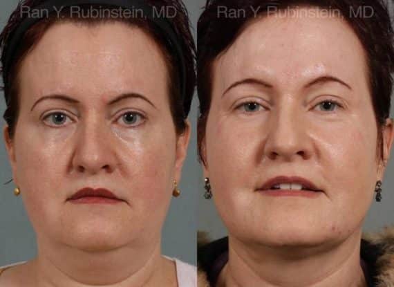 Laser Lift Precision Tx Before and After Photos in Newburgh, NY, Patient 13260