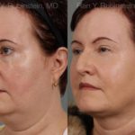 Laser Lift Precision Tx Before and After Photos in Newburgh, NY, Patient 13260