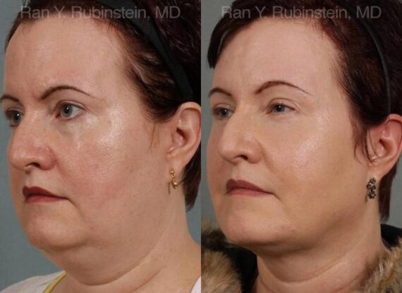 Laser Lift Precision Tx Before and After Photos in Newburgh, NY, Patient 13260