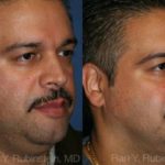 Smart Lipo Neck Before and After Photos in Newburgh, NY, Patient 13268