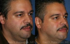 Smart Lipo Neck Before and After Photos in Newburgh, NY, Patient 13268