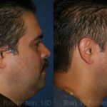 Smart Lipo Neck Before and After Photos in Newburgh, NY, Patient 13268