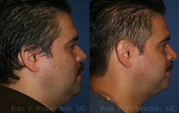 Smart Lipo Neck Before and After Photos in Newburgh, NY, Patient 13268