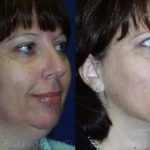 Smart Lipo Neck Before and After Photos in Newburgh, NY, Patient 13273