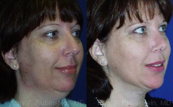 Smart Lipo Neck Before and After Photos in Newburgh, NY, Patient 13273