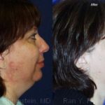 Smart Lipo Neck Before and After Photos in Newburgh, NY, Patient 13273