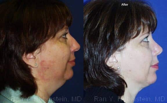 Smart Lipo Neck Before and After Photos in Newburgh, NY, Patient 13273