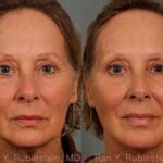 Laser Lift Precision Tx Before and After Photos in Newburgh, NY, Patient 13295