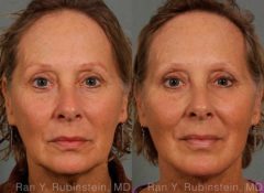 Laser Lift Precision Tx Before and After Photos in Newburgh, NY, Patient 13295