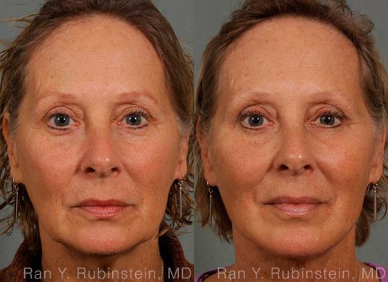 Laser Lift Precision Tx Before and After Photos in Newburgh, NY, Patient 13295