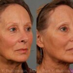 Laser Lift Precision Tx Before and After Photos in Newburgh, NY, Patient 13295