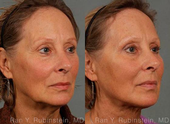 Laser Lift Precision Tx Before and After Photos in Newburgh, NY, Patient 13295