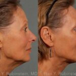 Laser Lift Precision Tx Before and After Photos in Newburgh, NY, Patient 13295