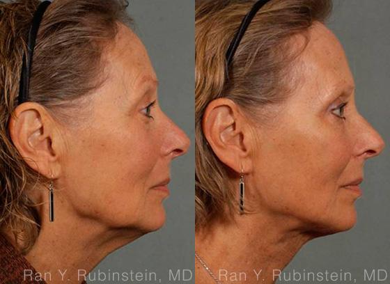 Laser Lift Precision Tx Before and After Photos in Newburgh, NY, Patient 13295