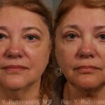 Laser Lift Precision Tx Before and After Photos in Newburgh, NY, Patient 13304