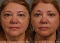 Laser Lift Precision Tx Before and After Photos in Newburgh, NY, Patient 13304