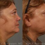 Laser Lift Precision Tx Before and After Photos in Newburgh, NY, Patient 13304