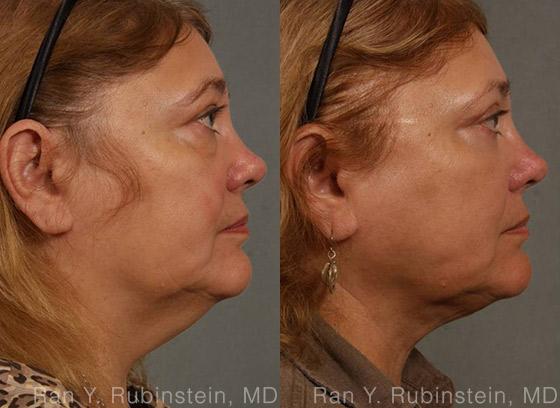 Laser Lift Precision Tx Before and After Photos in Newburgh, NY, Patient 13304