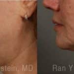 Laser Lift Precision Tx Before and After Photos in Newburgh, NY, Patient 13309