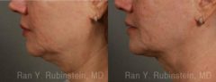 Laser Lift Precision Tx Before and After Photos in Newburgh, NY, Patient 13309