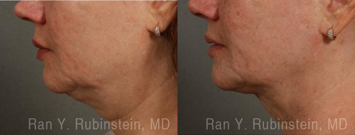 Laser Lift Precision Tx Before and After Photos in Newburgh, NY, Patient 13309