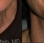 Botox Before and After Photos in Newburgh, NY, Patient 12282