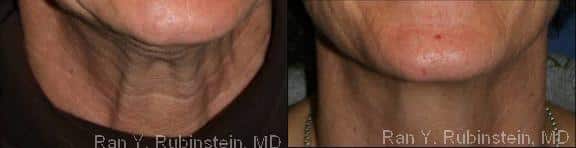 Botox Before and After Photos in Newburgh, NY, Patient 12282