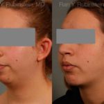 Chin Augmentation Before and After Photos in Newburgh, NY, Patient 12379