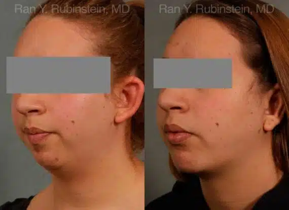 Chin Augmentation Before and After Photos in Newburgh, NY, Patient 12379