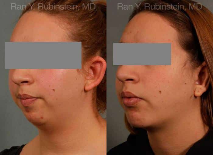 Chin Augmentation Before and After Photos in Montvale, NJ, Patient 12379